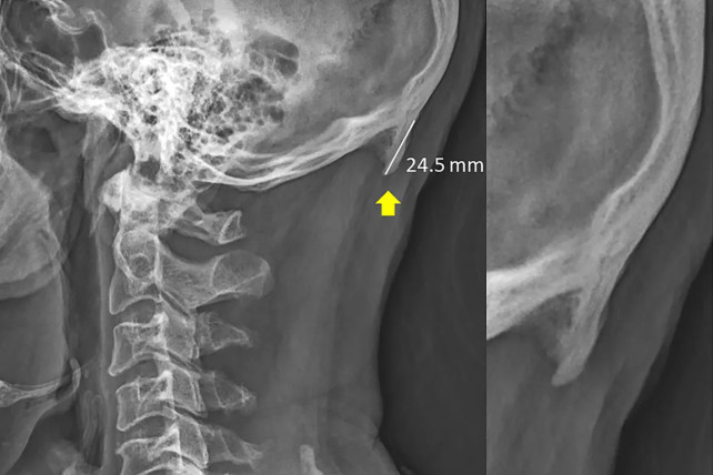 External occipital protuberance 24.5 mm